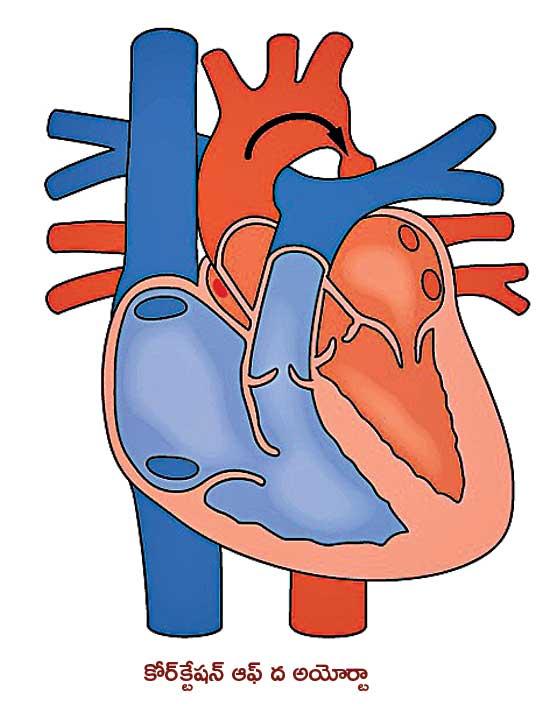 Congenital Heart Disease