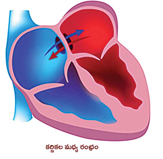 Congenital Heart Disease