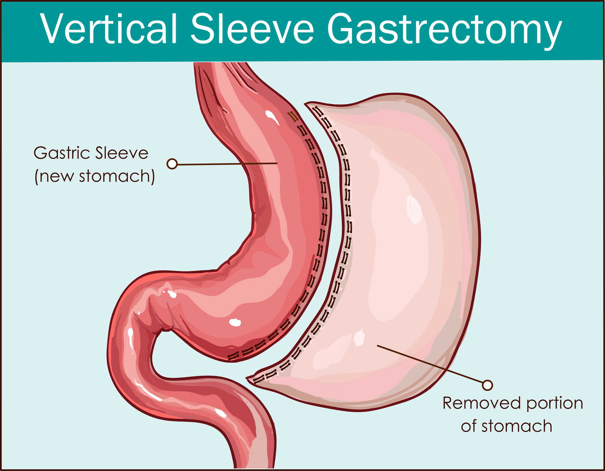 bariatric-surgery-types-and-effects-of-surgery