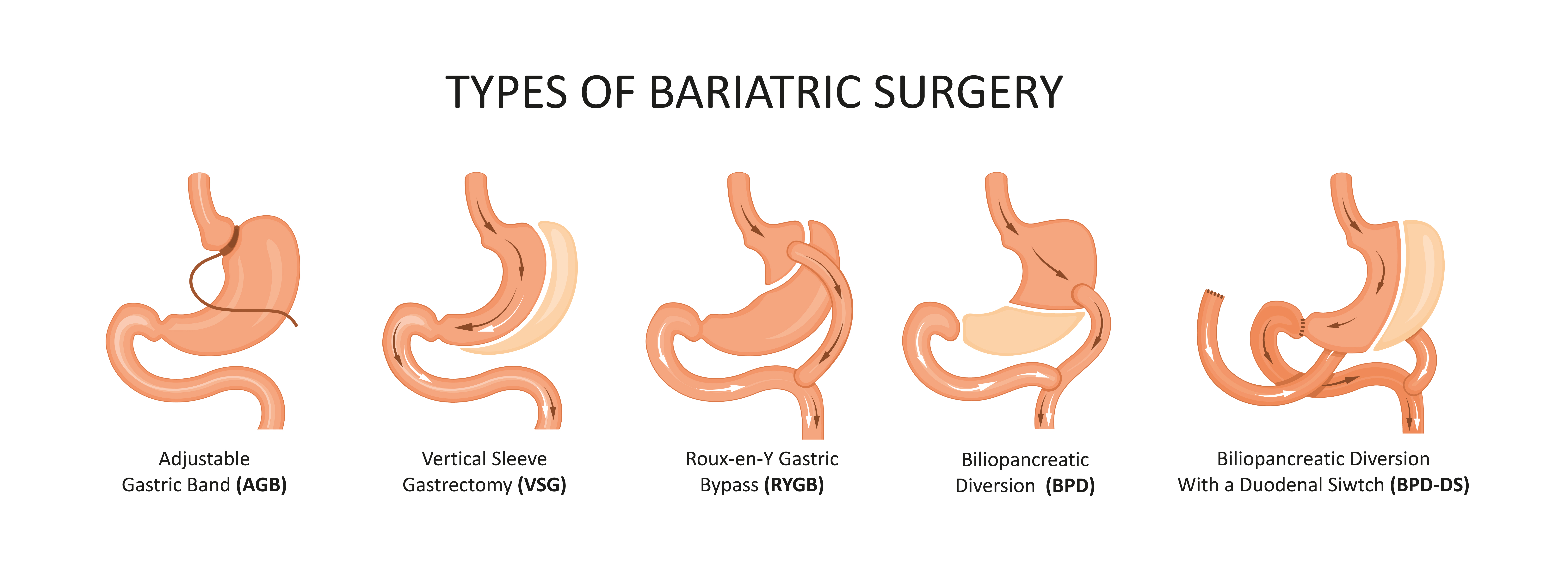 bariatric-surgery-types-and-effects-of-surgery