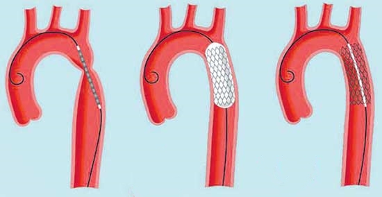 High blood pressure problem in Children