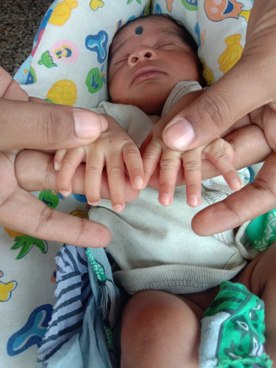 Baby in Chittoor district born with 23 fingers