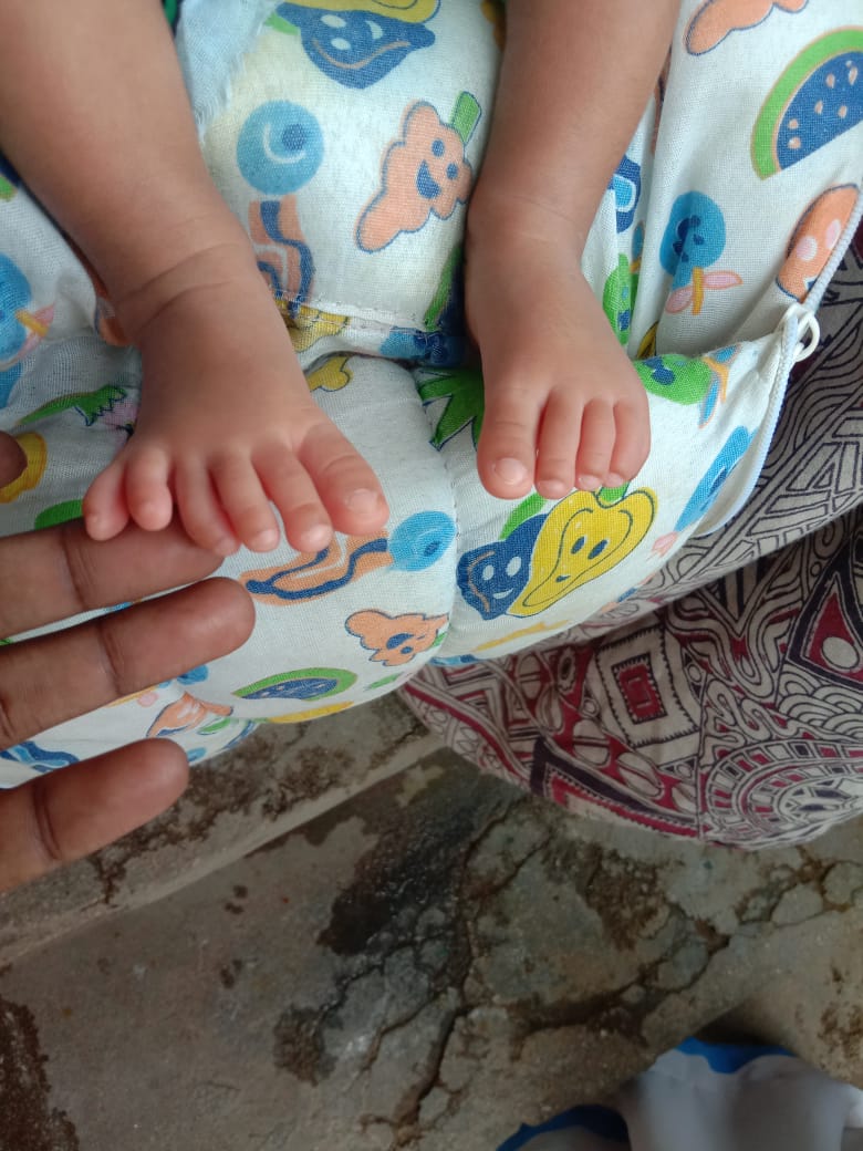 Baby in Chittoor district born with 23 fingers