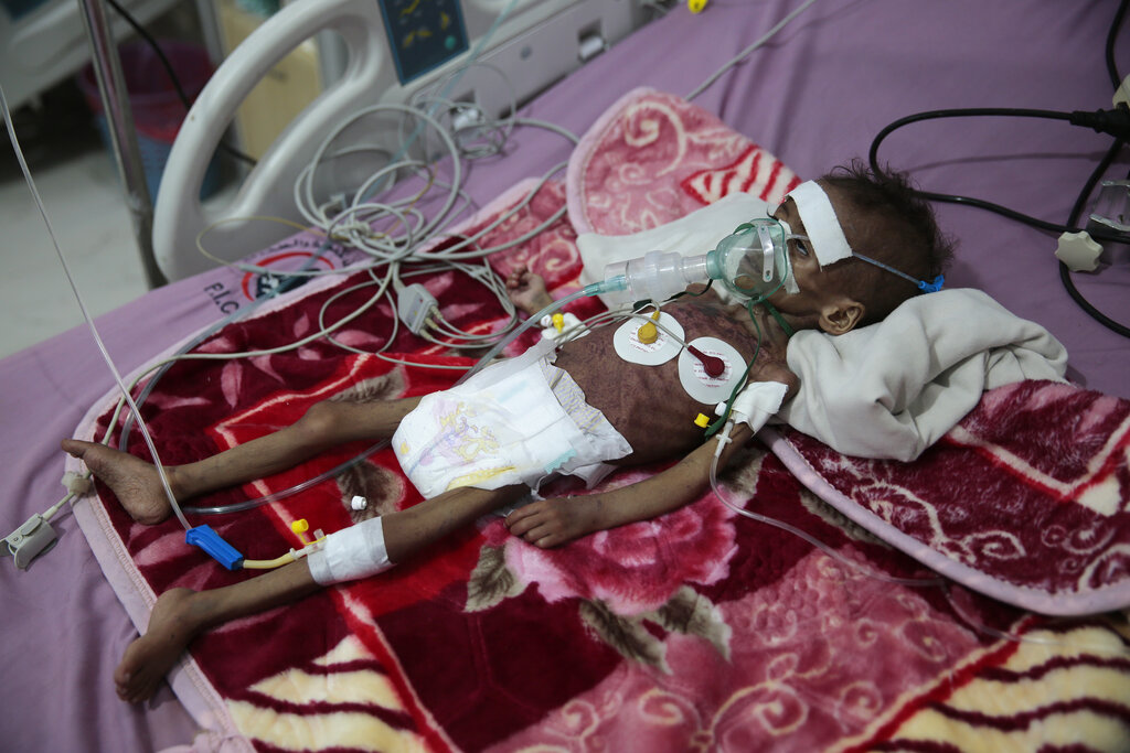 In this Nov. 3, 2020, file photo, malnourished girl, Rahmah Watheeq, receives treatment at a feeding center at Al-Sabeen hospital in Sanaa, Yemen. Countries like Lebanon, Syria, Iraq, Lebanon and Yemen are all teetering on the brink of humanitarian catastrophe with an economic implosion that threatens to throw the region into even deeper turmoil.