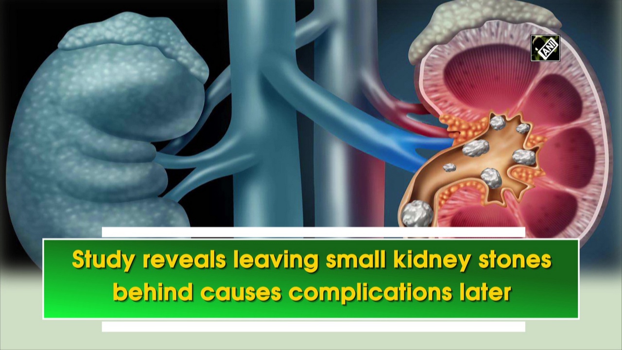 Small Kidney Stones Can Cause Complications