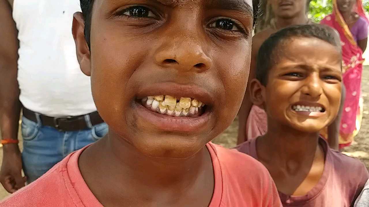 बच्चों के दांतों में पीलापन