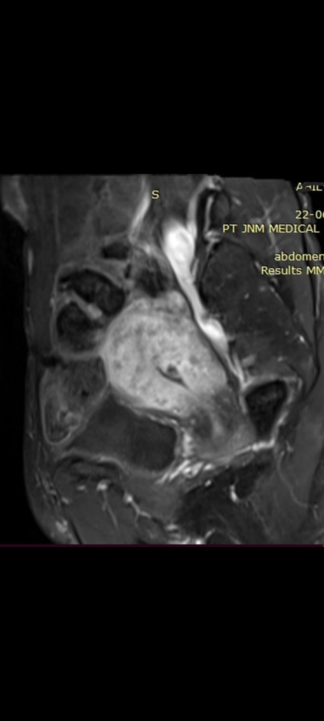 treatment of cricket ball size uterine lump