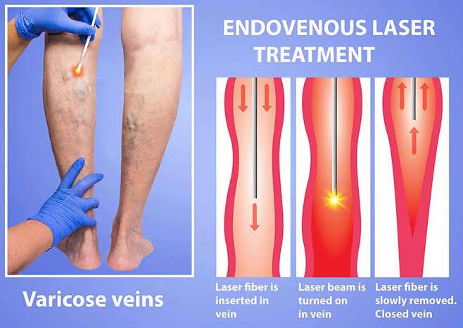 deep vein thrombosis disease