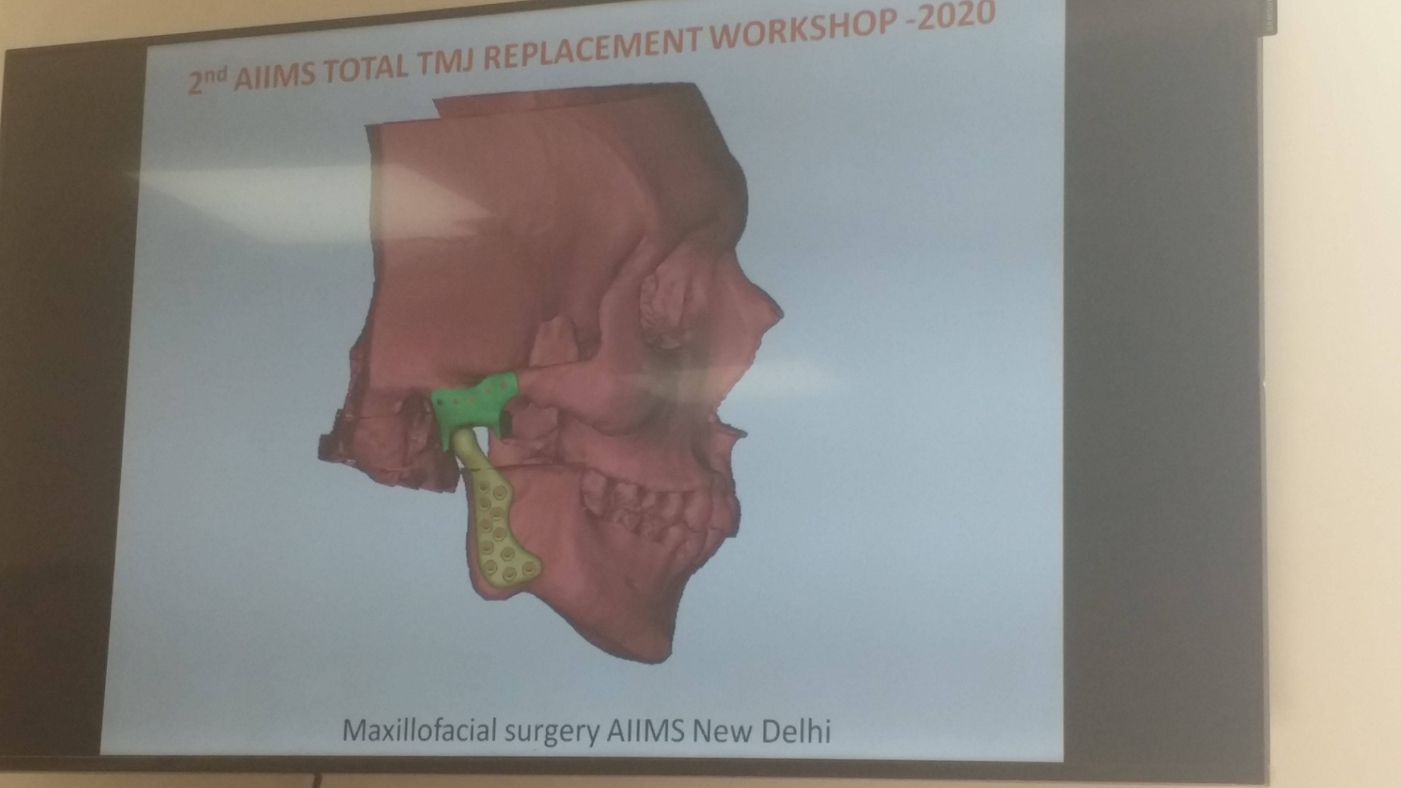 Now jaw operation will done with new technology