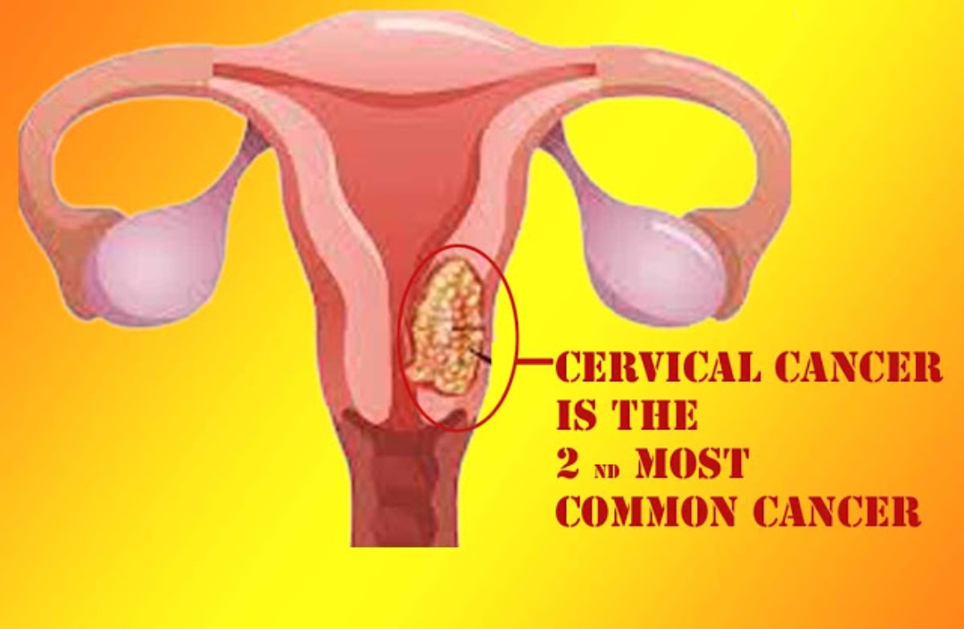 Cervical Cancer on World Cancer Day