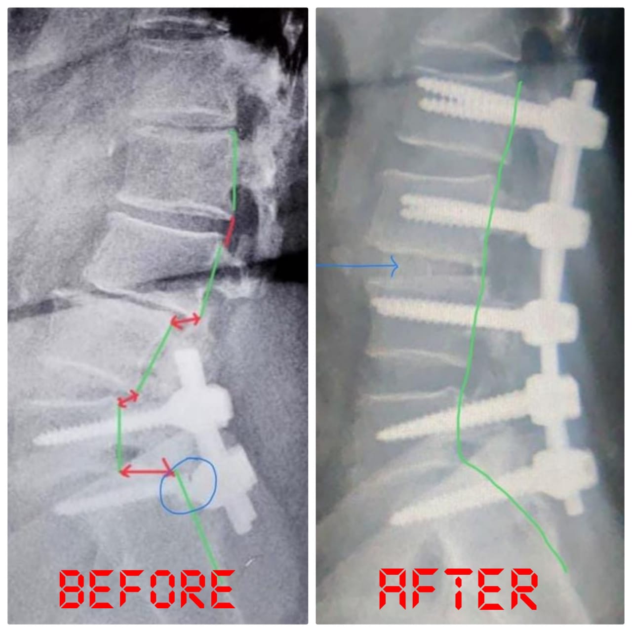 Revision Spine Surgery