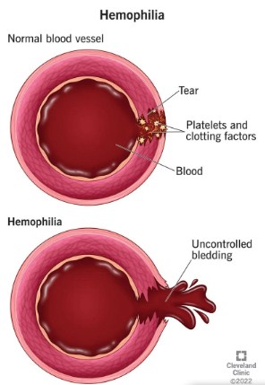 World hemophilia day 2023