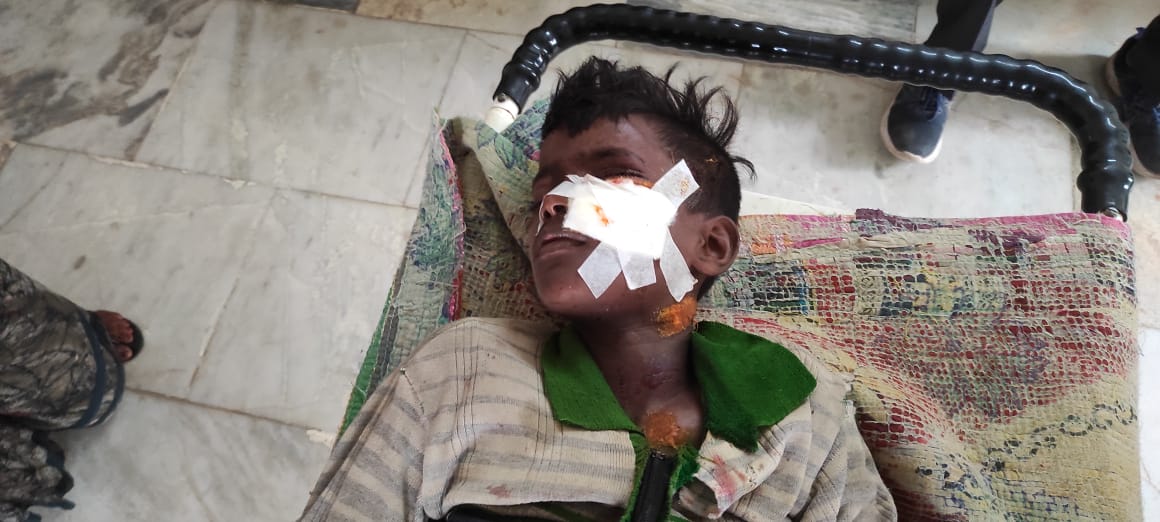 Child injured due to bomb explodes in Sahibganj