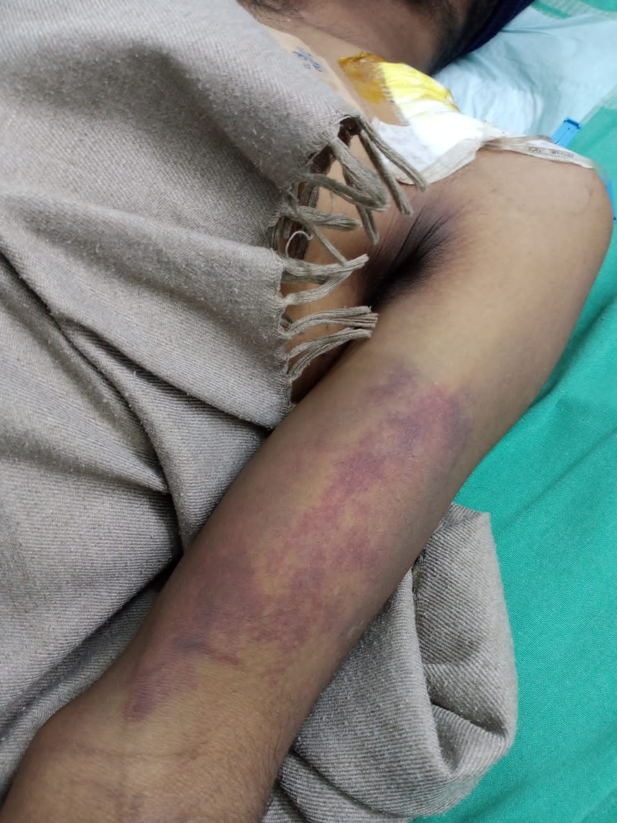 ಪೊಲೀಸರ ಹೊಡೆತಕ್ಕೆ ಬಲಗೈ ಕಳೆದುಕೊಂಡ ಯುವಕ,Young boy lost right hand by police assault in bengaluru