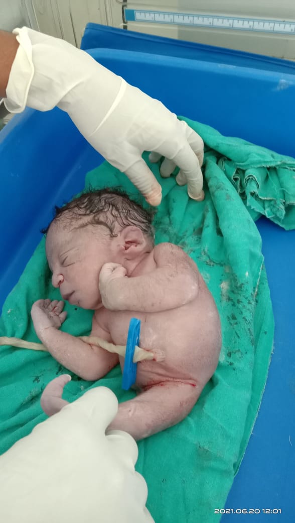 Single legged baby born in Hubli