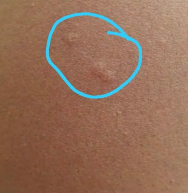 Three syringe marks on woman's shoulder