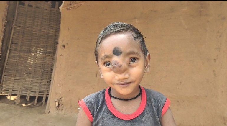 ଅସ୍ୱାଭାବିକ ଭାବେ ମୁହଁରେ ବଢୁଛି ମାଂସ ପିଣ୍ଡୁଳା0
