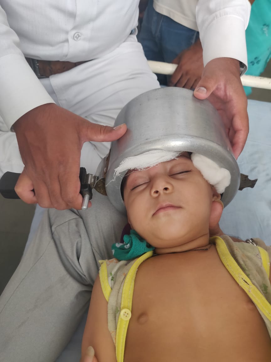 cooker stuck in the head of a one year old girl