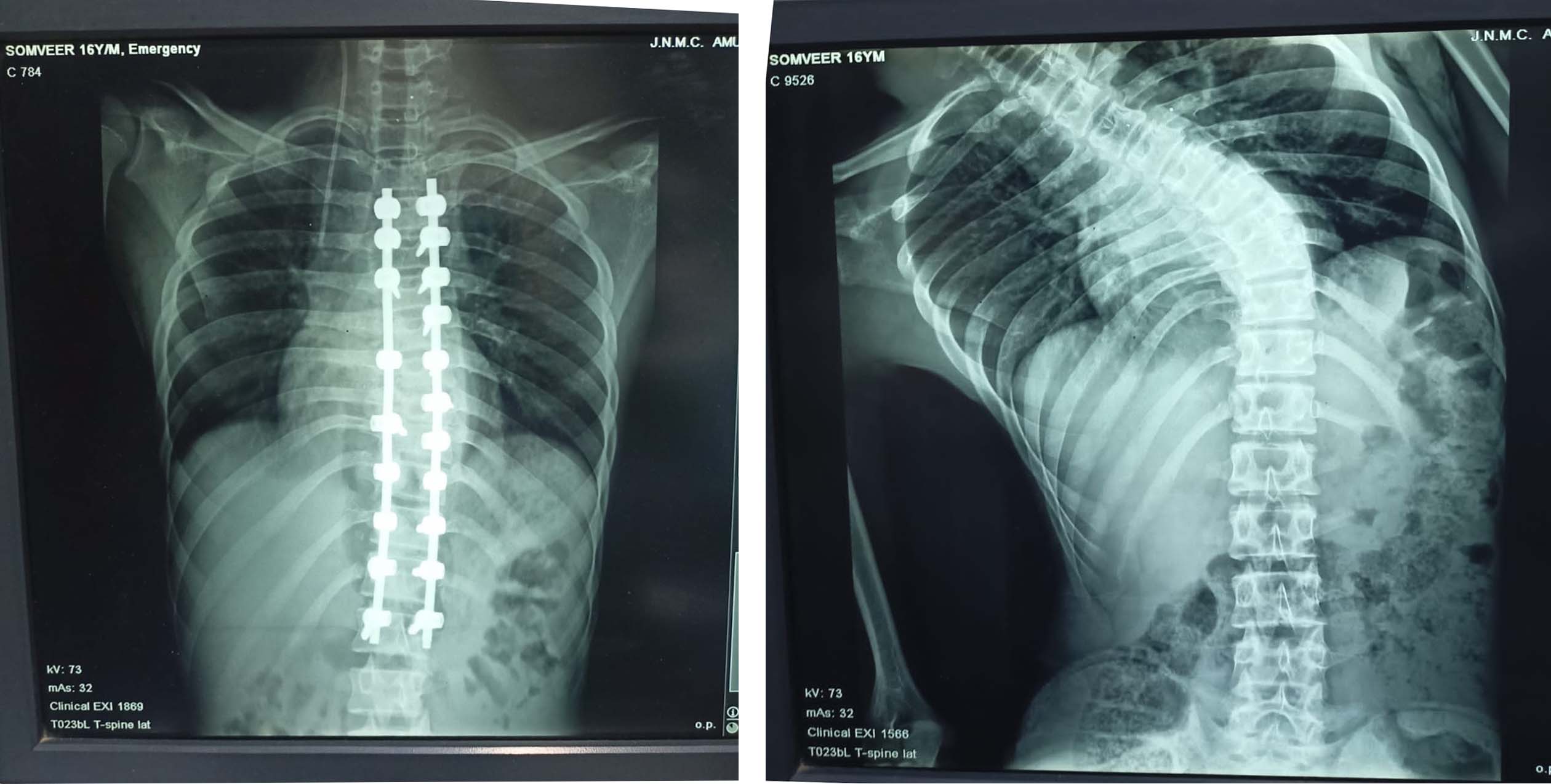 Successful Spinal Operation at JNMCH