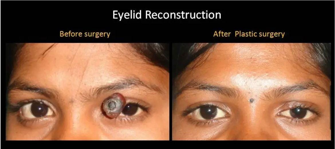 Plastic surgery in Prayagraj SRN Hospital . Cosmetic Surgery in SRN Hospital Prayagraj .