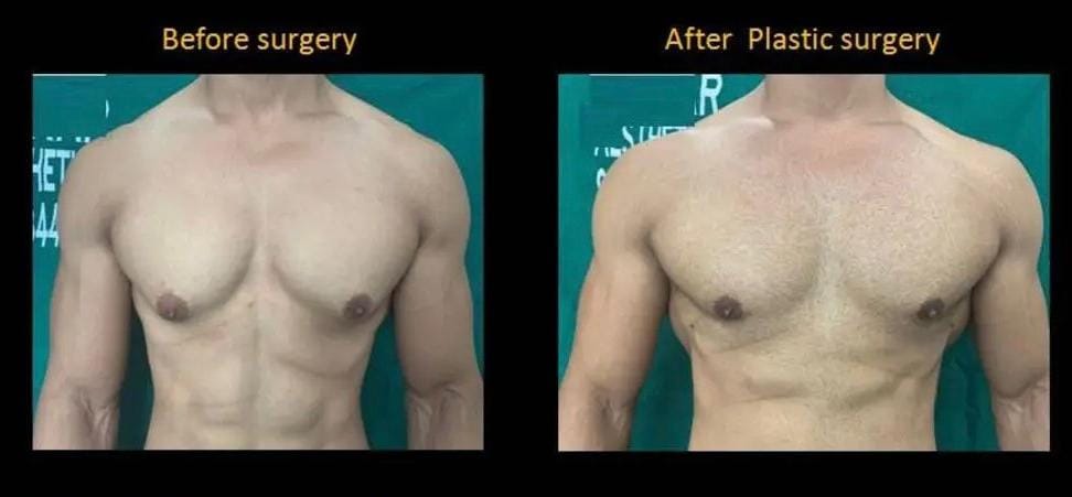 Plastic surgery in Prayagraj SRN Hospital . Cosmetic Surgery in SRN Hospital Prayagraj .