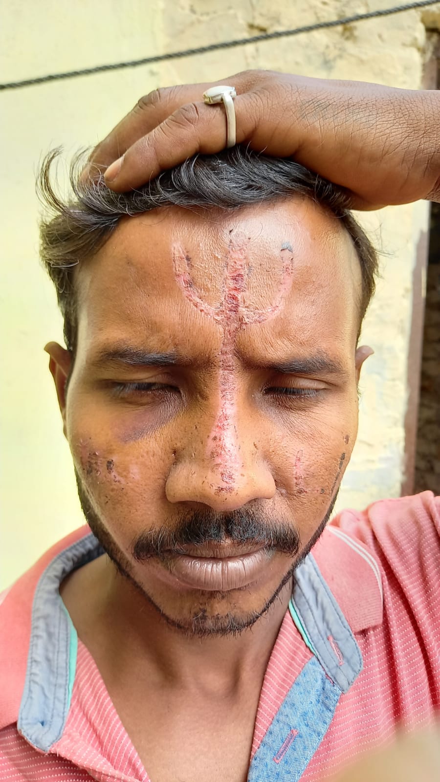 attack Dalit youth with acid in sharanpur