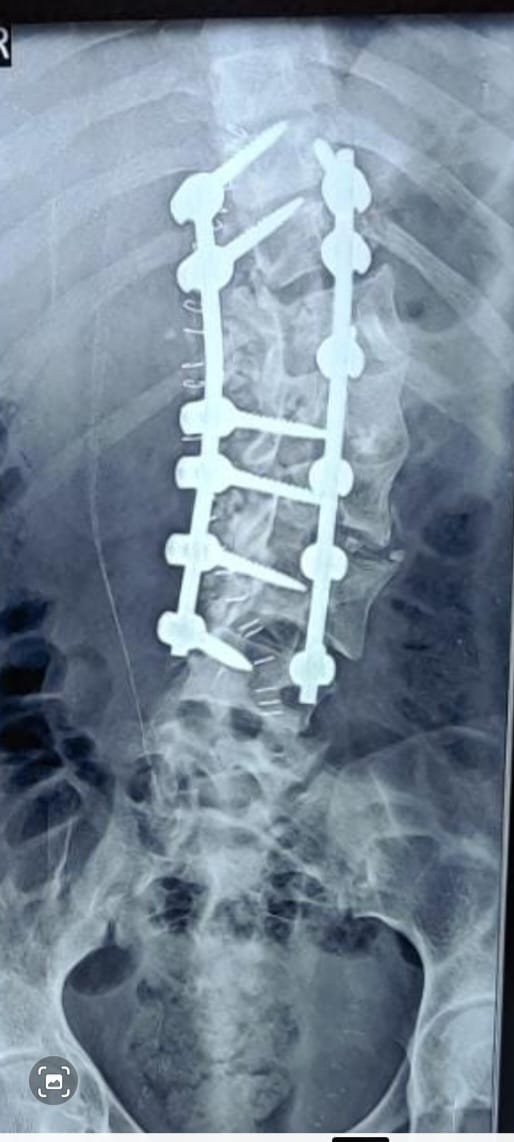 Rare surgery at NRS Hospital kolkata to girl suffering from spinal cord disease