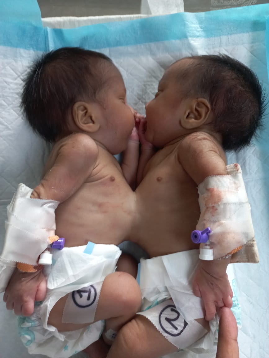 NRS doctors perform rare surgery to separate conjoined babies