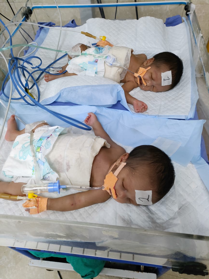 NRS doctors perform rare surgery to separate conjoined babies